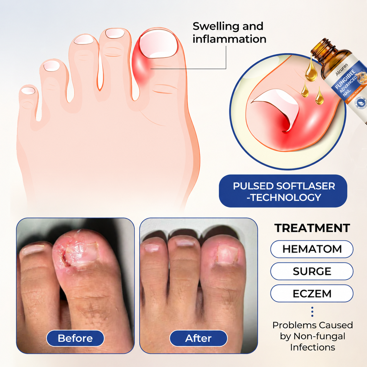 Alcuras® FungiBee Advanced Nail Repair Solution