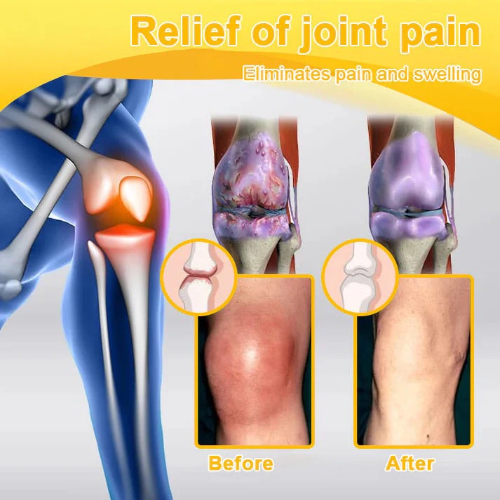 Alcuras™ Botulinum Toxin & Bee Venom Pain-Relief Bone Healing Cream🐝💎