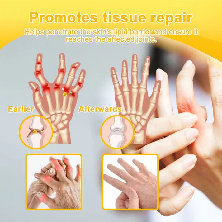 Alcuras™ Botulinum Toxin & Bee Venom Pain-Relief Bone Healing Cream🐝💎